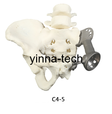 3D打印與醫(yī)療——外科金屬植入物